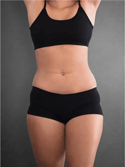 Bauch – frontal – vorher